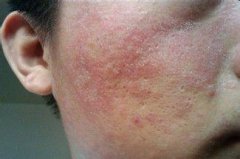 患有过敏性皮炎湿疹有哪些