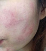 皮肤瘙痒有哪些症状特点