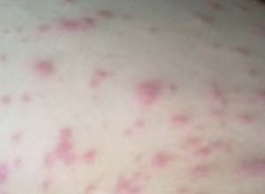 皮肤瘙痒有哪些具体症状