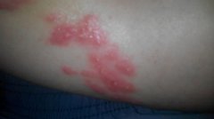 湿疹有哪些常见症状