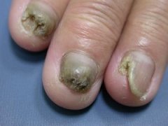 灰指甲有哪些明显的症状