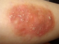 慢性湿疹有哪些病因呢