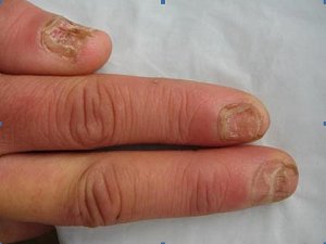 灰指甲有哪些常见的病因呢