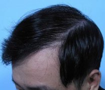 男性斑秃有哪些致病因素