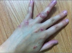 手部为什么会出现皮炎