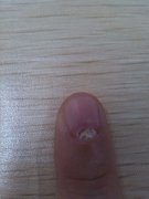 灰指甲有哪些临床表现