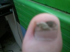 灰指甲的典型症状有哪些
