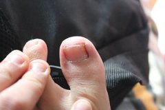 灰指甲的传染途径有哪些
