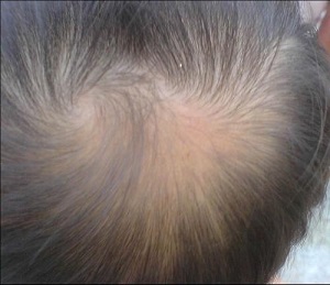 导致大量脱发的病因有哪些