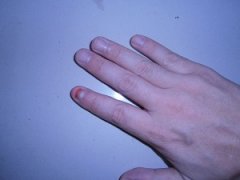 灰指甲有哪些分类表现