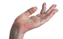 慢性湿疹临床有哪些症状