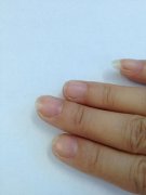 灰指甲有哪些预防方法