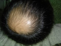 引发脱发的主要病因有哪些