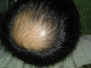 引发脱发的主要病因有哪些