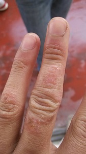 湿疹都会有哪些因素?