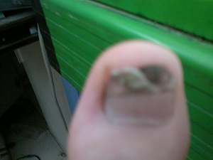灰指甲主要会有哪些危害