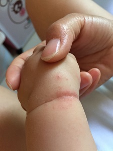 对待湿疹宝宝,家长有什么护理方法吗?