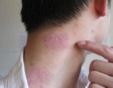 胆碱性荨麻疹需要注意什么