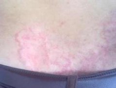 背上出现湿疹的症状都有哪些