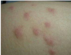 荨麻疹出现后一般有哪些症状